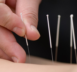 Acupuncture also helps Acupuncture also helps