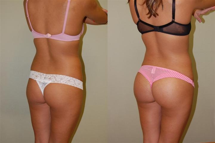 Butt Implant Results. butt implants before and after