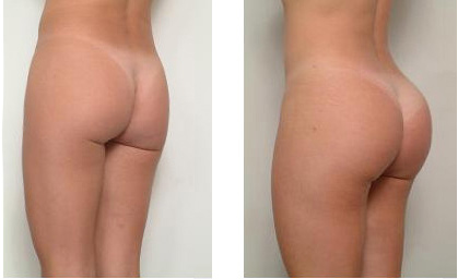 Butt Implants Before And After 48