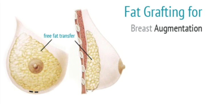Breast Fat Transplant 32