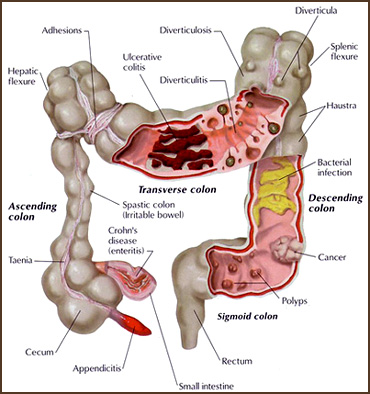 Small Intestine Colon Cleanse