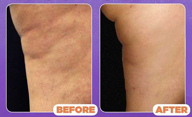 TRULY AMAZING! Cellulaze Laser Cellulite Treatment