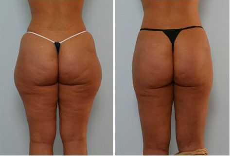 of liposuction form best