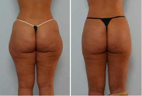 fastest way to lose cellulite