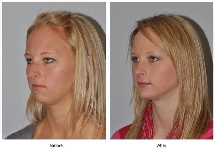 nose rhinoplasty attractive before job surgery too low procedure building looks breathe