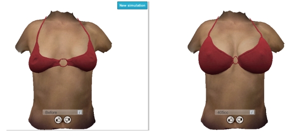 3D-breast-enhancement-imaging