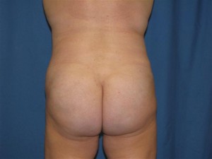 after-buttocks-augmentation-with-fat-grafting-brazilian-butt-lift