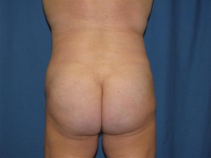 after-buttocks-augmentation-with-fat-grafting-brazilian-butt-lift