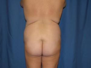 before-buttocks-augmentation-with-fat-grafting