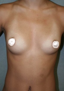TUBA-breast-augmentation-before-photo