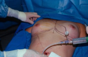 TUBA-breast-enlargement-procedure