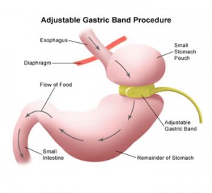 gastric-lap-band