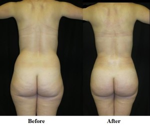 brazilian-butt-lift-before-and-after-rear-view
