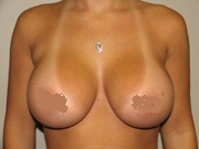 breast-augmentation-after