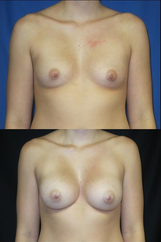 breast-augmentation-before-and-after