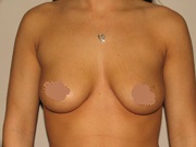 breast-augmentation-before