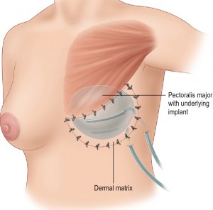 breast-expansion-with-saline