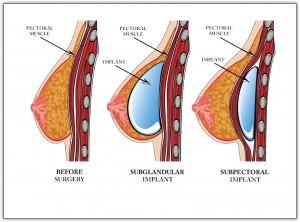 breast-implant-placement