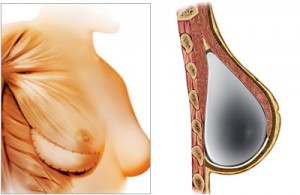 breast-reconstruction-with-implant