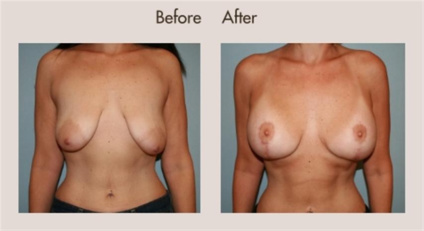 breast-lift-with-breast-augmentation