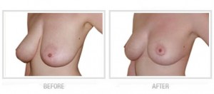 breast-lift-before-after