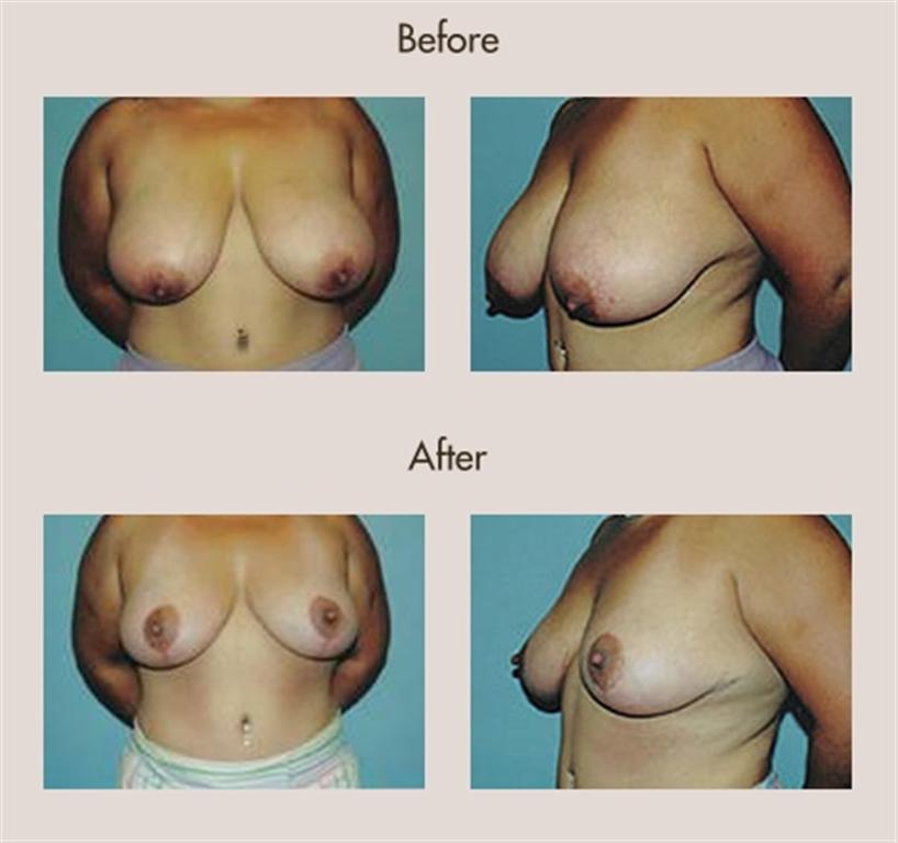 breast-lift-before-and-after