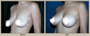 breast-lift-with-breast-augmentation