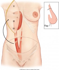 breast-reconstruction-abdominal-flap