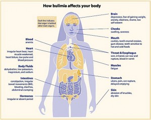 bulimia-eating-disorder