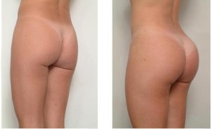 gluteal-implants-before-after