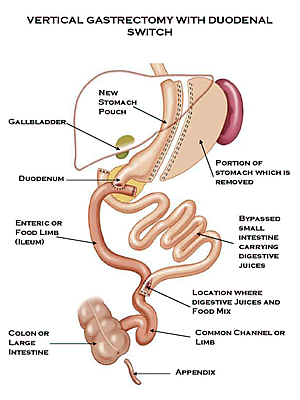 bariatric-duodenal-switch