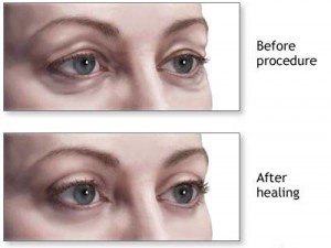 eyelid-surgery-before-after