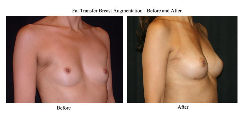 Does Fat Transfer Breast Augmentation Work