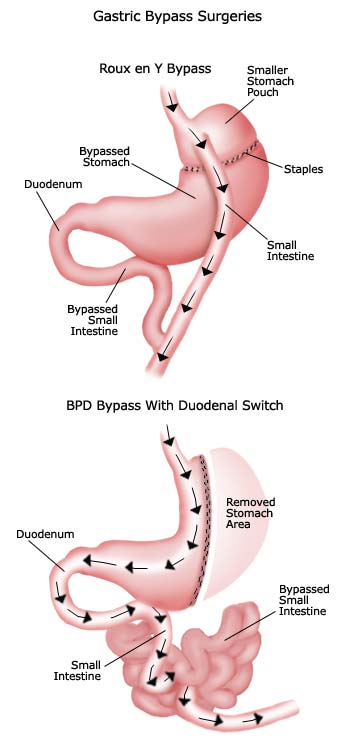 bariatric-gastric-bypass-surgery