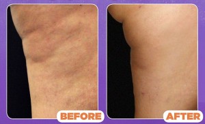 cellulaze-laser-cellulite-treatment