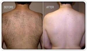 laser-hair-removal