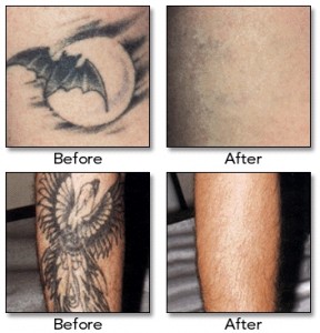 laser-tattoo-removal