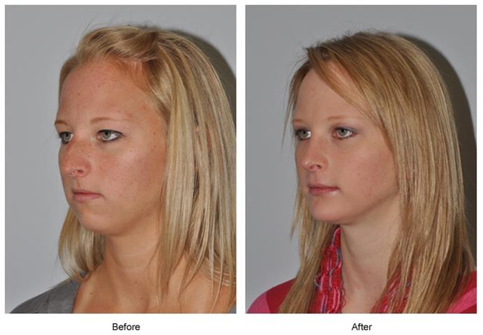 Rhinoplasty: Building a New, More Attractive Nose.