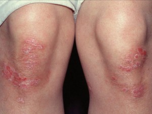 psoriasis-on-the-knees