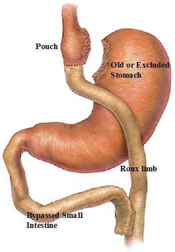 stomach-staple-surgery