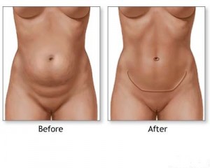 tummy-tuck-before-and-after