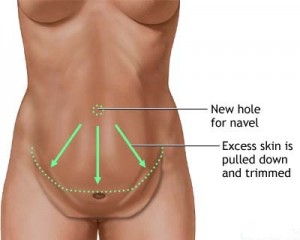 tummy-tuck-procedure