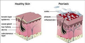 causes-of-psoriasis