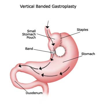 bariatric-surgery-VBG